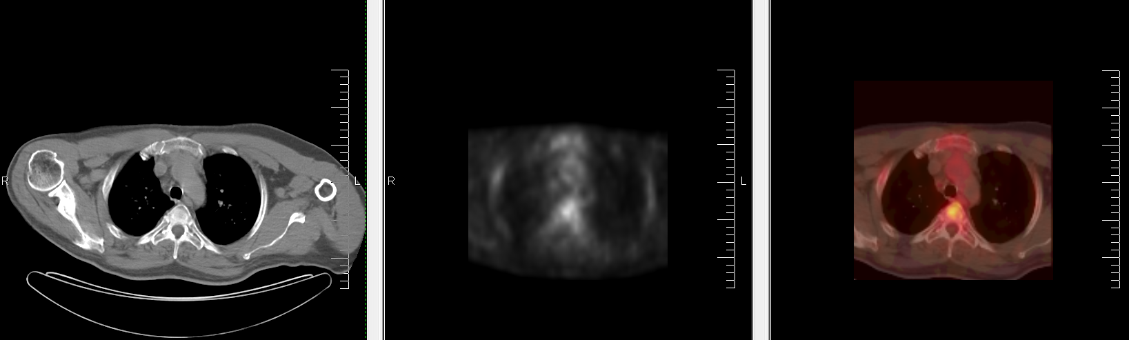 PET / CT Fusion Example