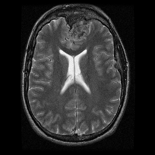 Brain Analysis Function - Before