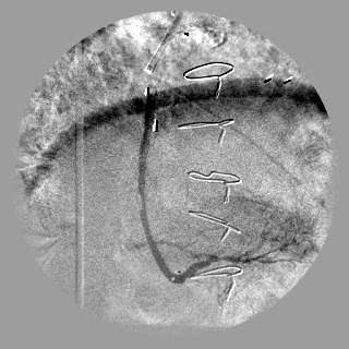 Digital Subtraction Angiography Function - After