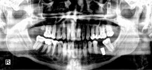 Multiscale Enhancement Function - After