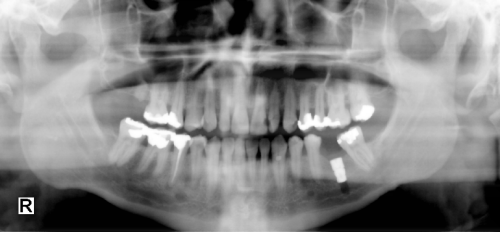 Tissue Equalize Function - Before