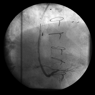 Digital Subtraction Angiography Function - Before