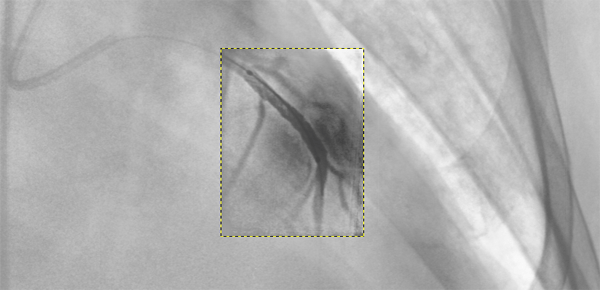 Stent Enhancement Function - After