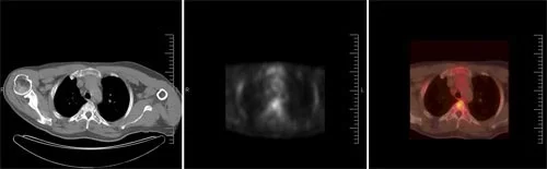 pet ct fusion image